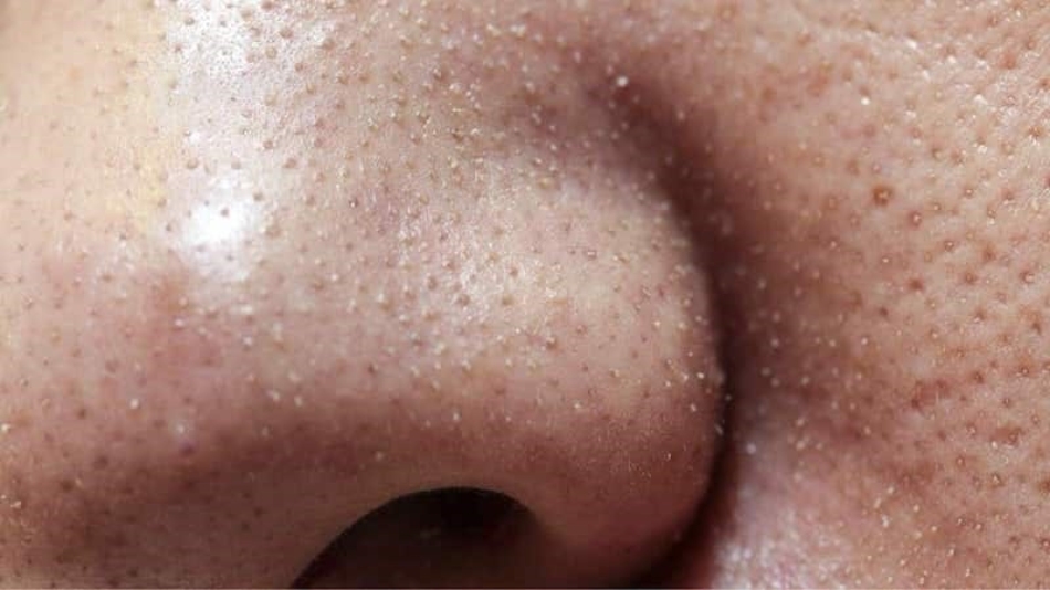 Top 4 Mẹo Chăm sóc da sợi bã nhờn