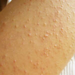 Bị mụn ẩn ở cánh tay có nguy hiểm không ?